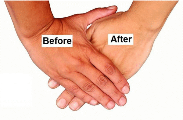 Before and after hands - One hand untreated (Darker) and the other treated