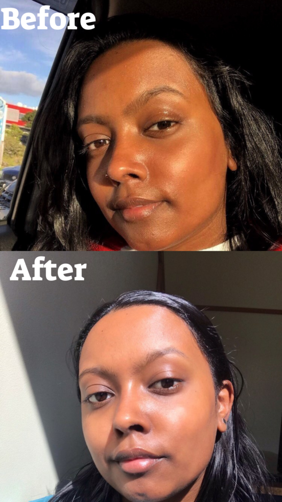 Hyperpigmentation Before & After Hyperpigmentation Before & After Photo